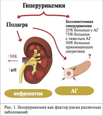 Гиперурикемия симптомы лечение